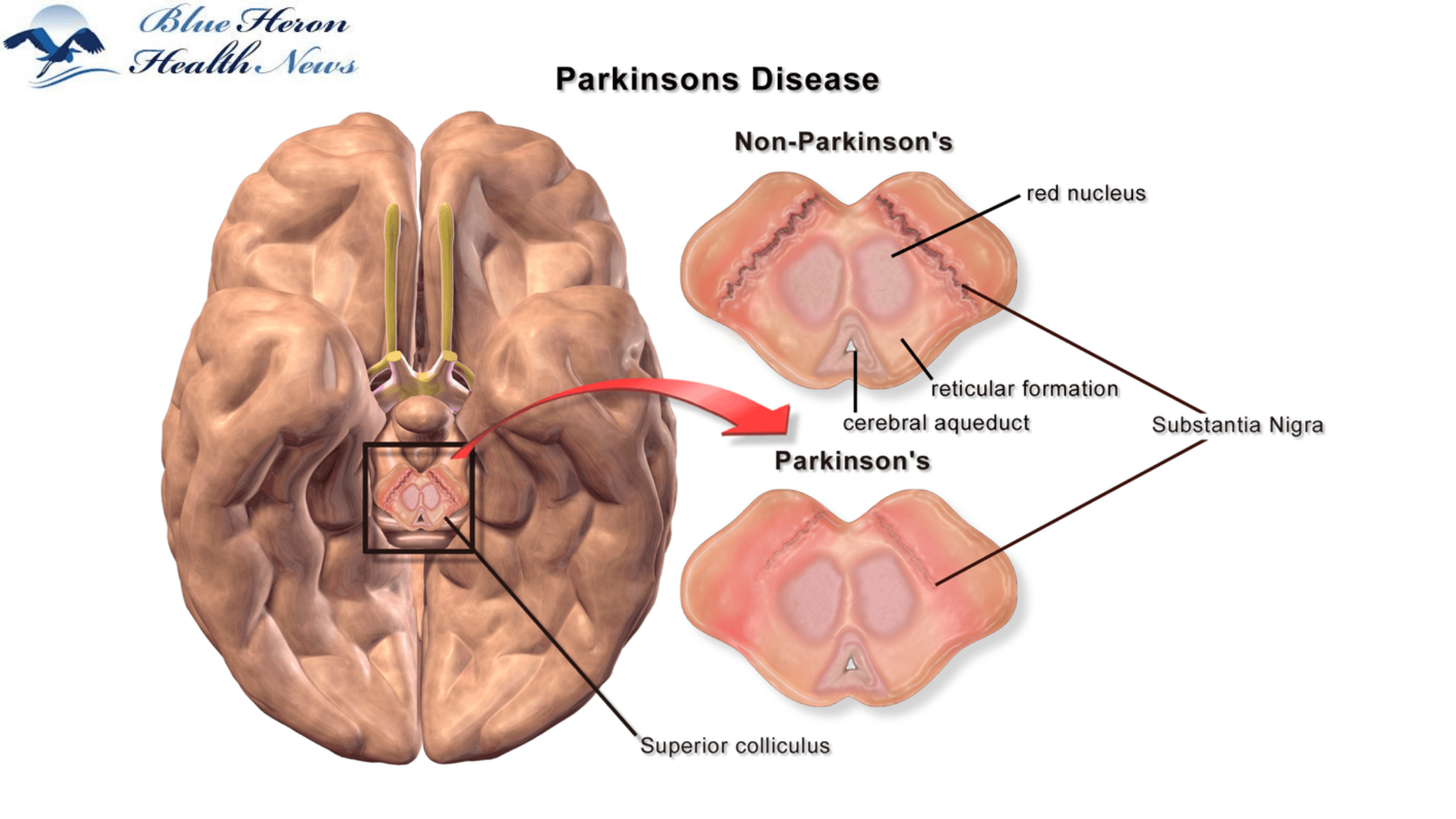 Parkinson's Protocol working