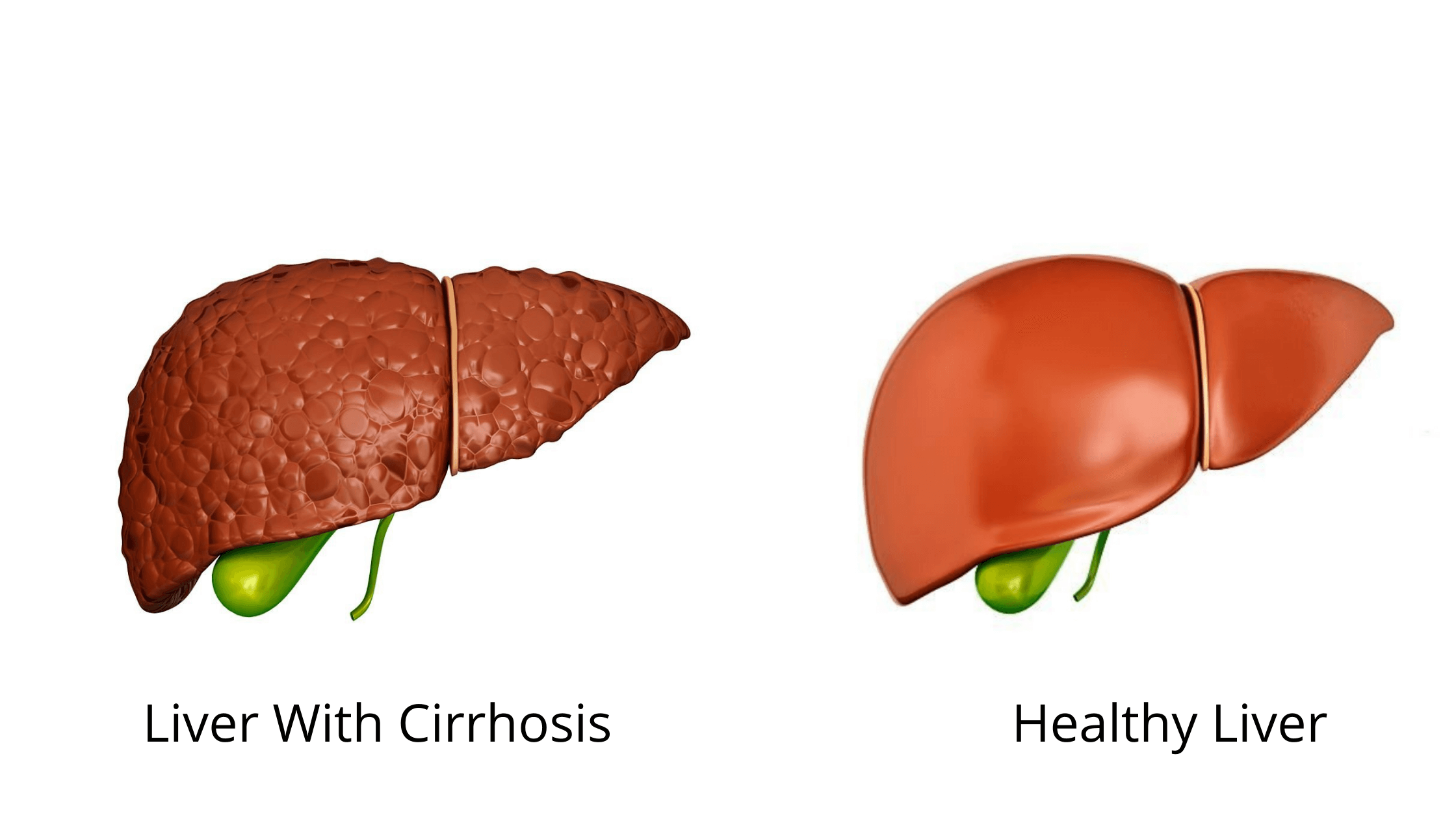 The Non Alcoholic Fatty Liver Disease Solution Results