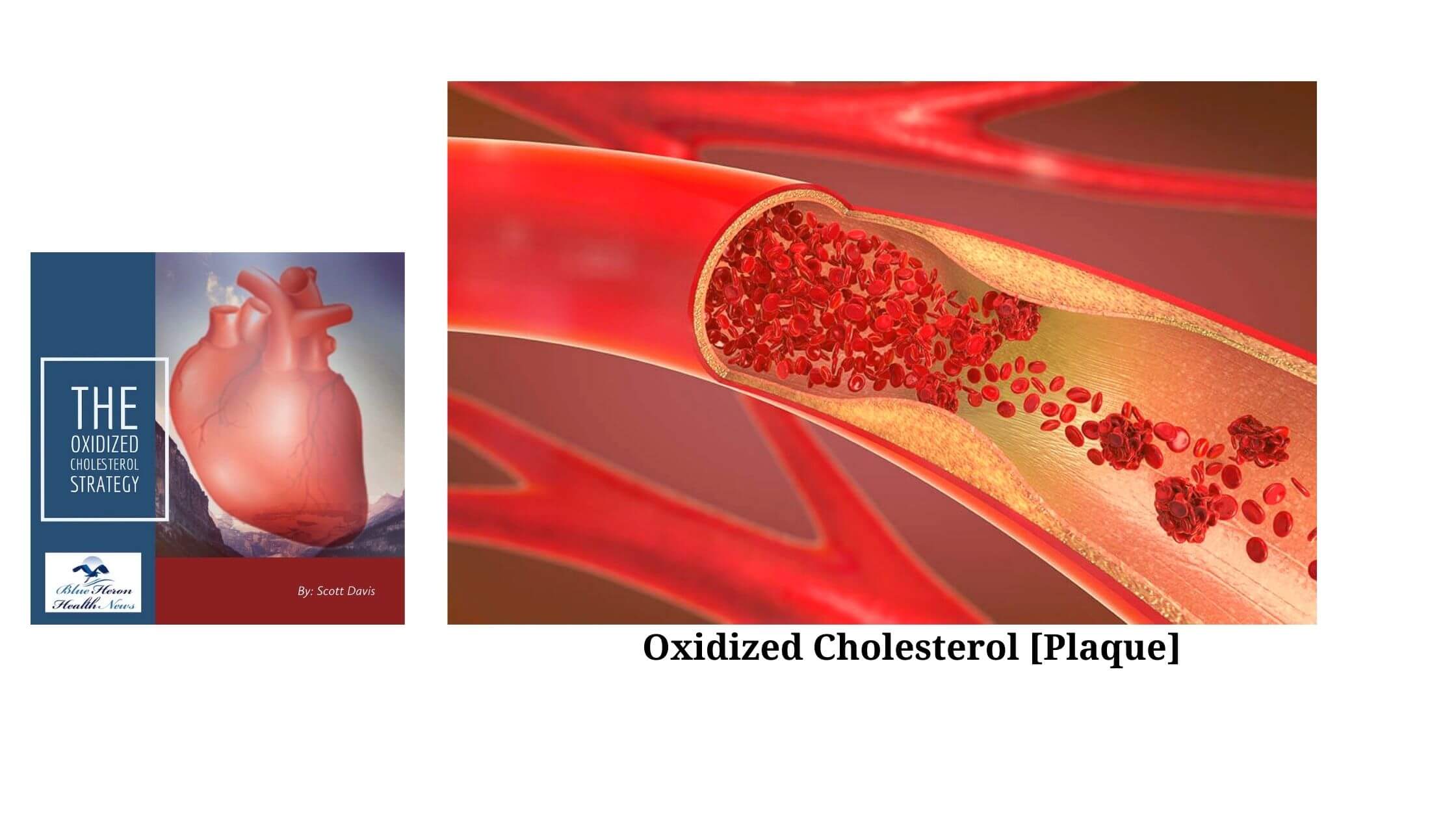 The Oxidized Cholesterol Strategy Working